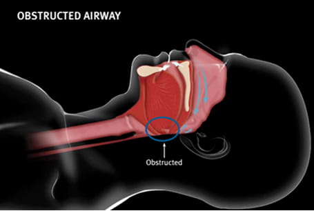 Obstructed Airway