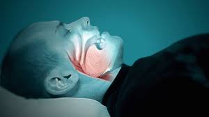 Mixed Sleep Apnea